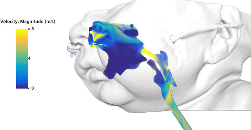 Flow modeling visuals developed and processed by Seattle Children&rsquo;s Custom Care team depict large inspiratory pressure gradients and airflow jets, aiding in the identification of Milo&rsquo;s early airway obstruction caused by Robin sequence