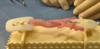 3-D printed airway model created in Seattle Children&rsquo;s Innovation Lab