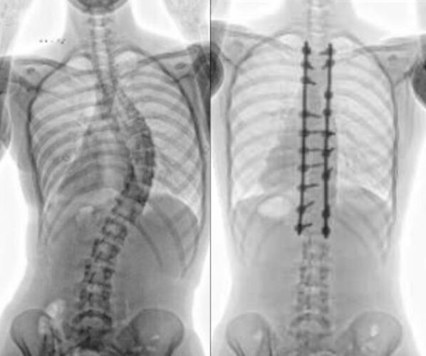 Figure 1 X-ray images of Lyla&rsquo;s spine at age 19 before and after receiving care in the Orthopedics and Spine Medicine Program at Seattle Children&rsquo;s Hospital