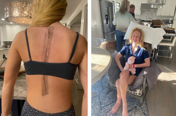 Figure 2 Lyla&rsquo;s early recovery at home, a) with her special post-operative dressing in place over her healing incision, and b) relaxing with extra pillows for comfort