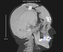 3D post-monobloc