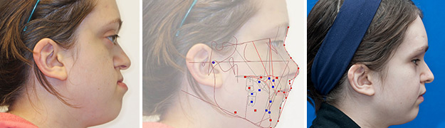 Face of girl with Crouzon syndrome before and after with computerized simulation