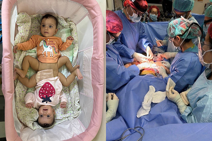 A two-part photo documenting a surgical journey: first, a high-angle view of conjoined twins resting together; second, the Seattle Children's surgical team performing the intricate separation surgery, illustrating the hospital's expertise in treating complex neonatal conditions.