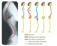 Patterns of sagittal deformity. Normal (green), Scheuermann kyphosis (red); hyperlordosis secondard to hip flexion contracture (blue); flat back (yellow); and thoracic lordosis (brown) with pulmonary compromise. Courtesy of 'Fundamentals of Pediatric Orthopedics,' © 2003 Lippincott Williams & Wilkins