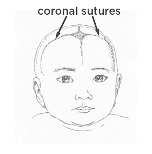 Drawing  of young child showing coronal sutures in the skull.
