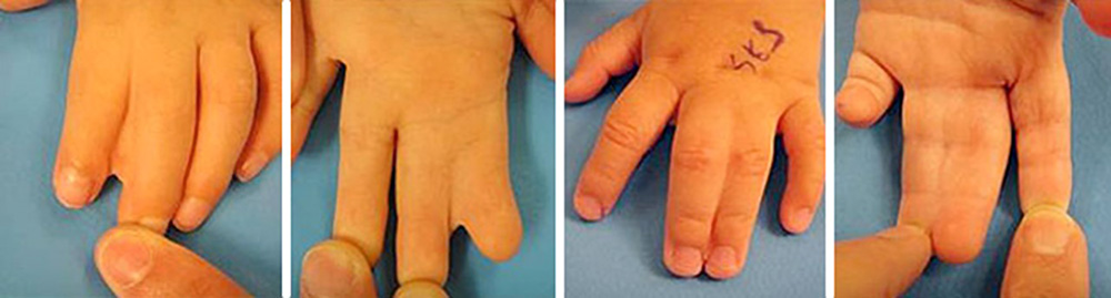 Four photos of children&rsquo;s hands with webbed skin between fingers