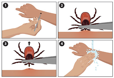 Illustration demonstrating the steps for tick removal