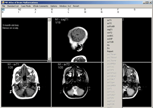 Brain Malformations Screen Shot 2