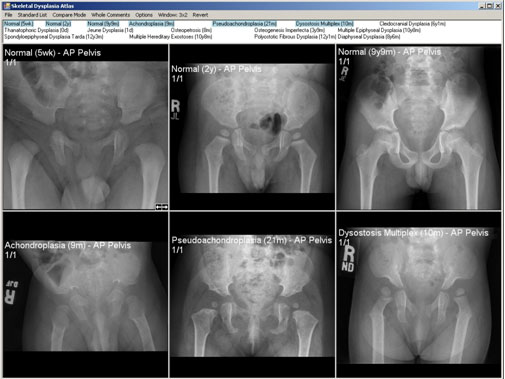 Skeletal dysplasia atlas with 3x2 grid demonstrating AP pelvis images of 3 normals and 3 skeletal dysplasias.