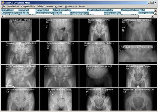 Opening screen of the skeletal dysplasia atlas in compare mode, displaying a 4x4 grid of AP pelvis images in a 