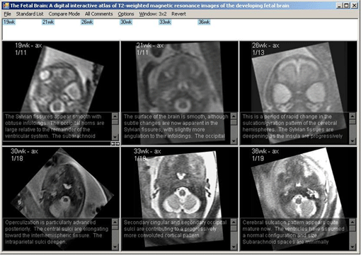 Fetal Brain Atlas Screen Shot 6