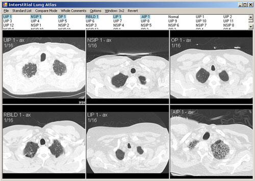 Interstitial Lung Atlas 1