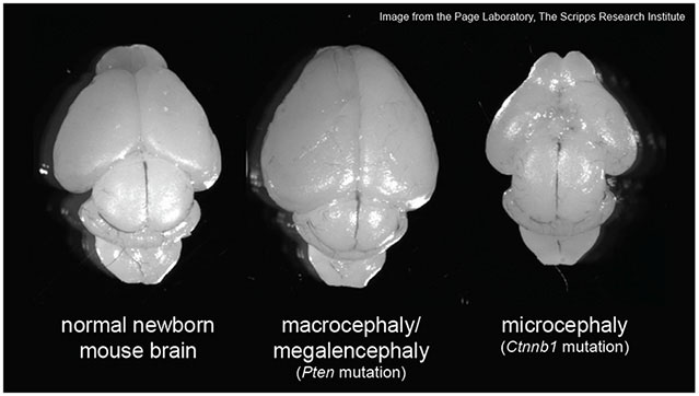 page-macrocephaly.jpg