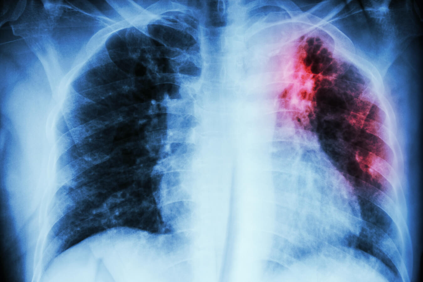Scan of lungs