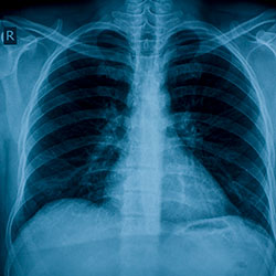 An X-ray of human lungs.